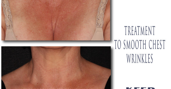 Sculptra BLT ™