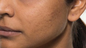 bellafill acne after 1