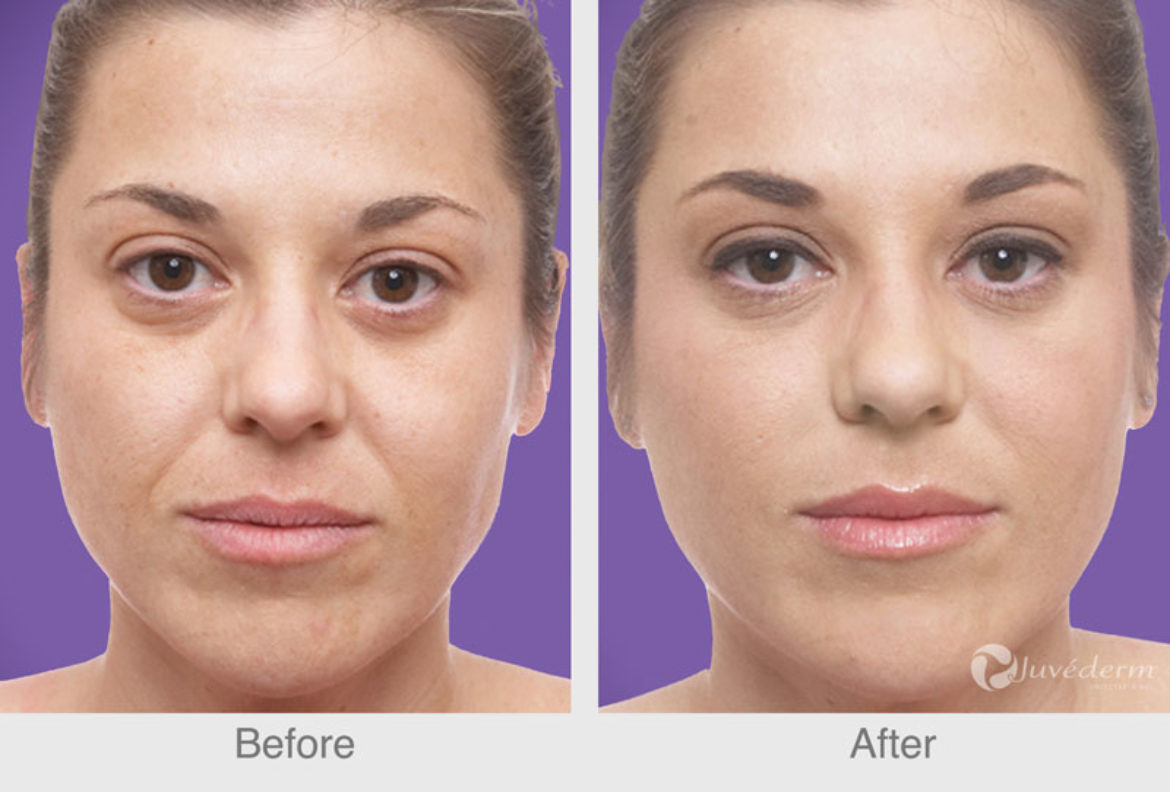 Juvederm-Jennifer-Before-After