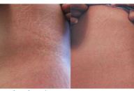 Can Micro-needling Help Treat Stretch Marks?