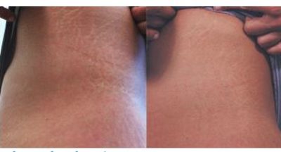 Can Micro-needling Help Treat Stretch Marks?