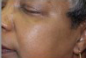 dpntreatment-after