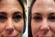 How To Get Younger Eyes Without Wrinkles