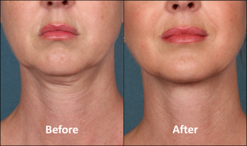 KYBELLA-Patient-Before-and-After-Front-view