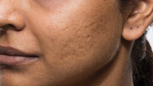 bellafill before acne 1
